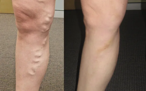 Effects of vascular care through varicose veins treatment and removal Leg after varicose veins removal and vascular care