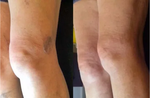 Ultrasound-guided sclerotherapy to treat spider and varicose veins Leg treated for spider and varicose veins through sclerotherapy
