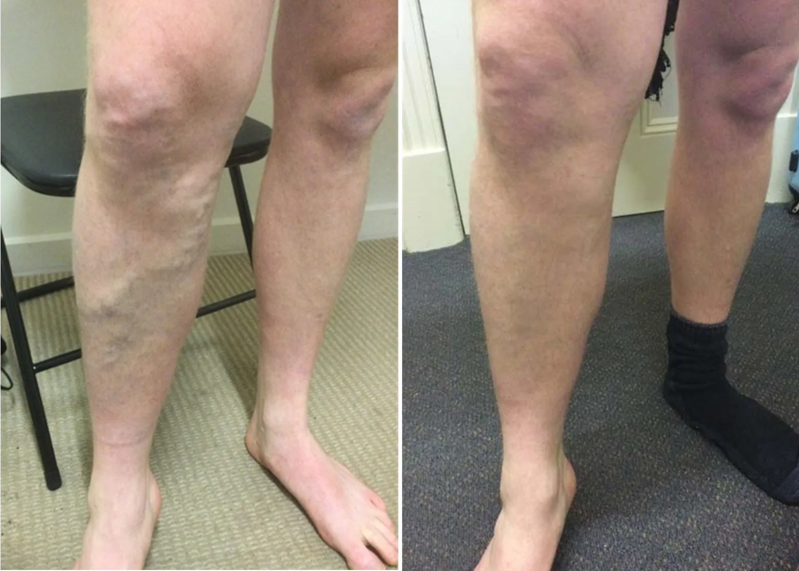 Leg underwent vein treatment and vascular care for varicose veins Vein treatment and vascular care on leg with varicose veins